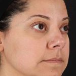 Neck Liposuction Before & After Patient #2752