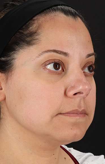 Neck Liposuction Before & After Patient #2752