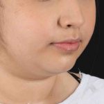 Neck Liposuction Before & After Patient #2774