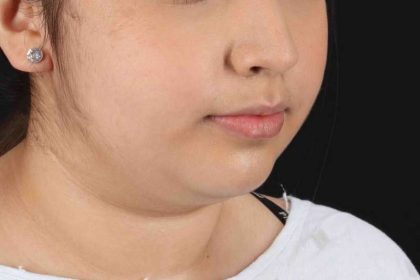 Neck Liposuction Before & After Patient #2774