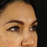 Browlift Before & After Patient #1352