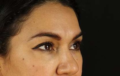 Browlift Before & After Patient #1352