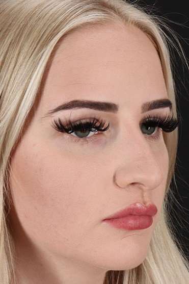 Rhinoplasty Before & After Patient #2807