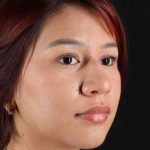 Rhinoplasty Before & After Patient #2829