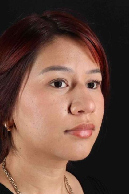 Rhinoplasty Before & After Patient #2829