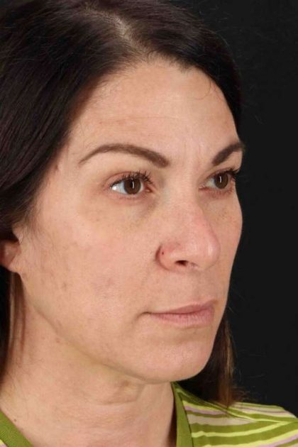 Rhinoplasty Before & After Patient #2851