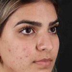 Rhinoplasty Before & After Patient #2862