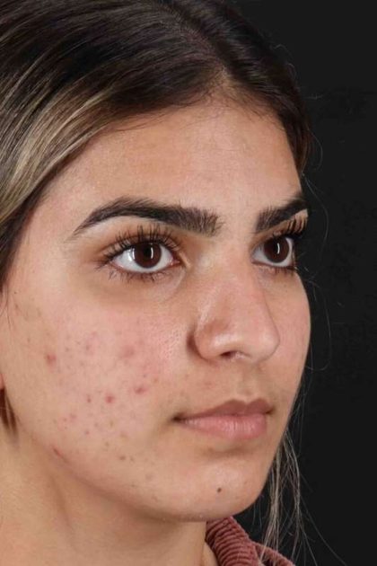 Rhinoplasty Before & After Patient #2862