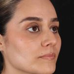 Rhinoplasty Before & After Patient #2873