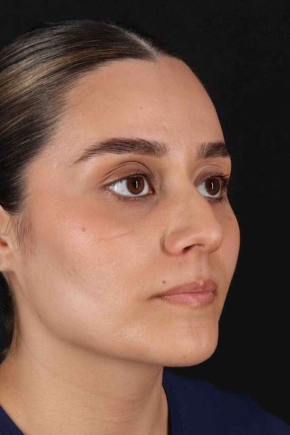 Rhinoplasty Before & After Patient #2873