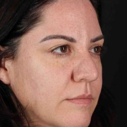 Browlift Before & After Patient #1363