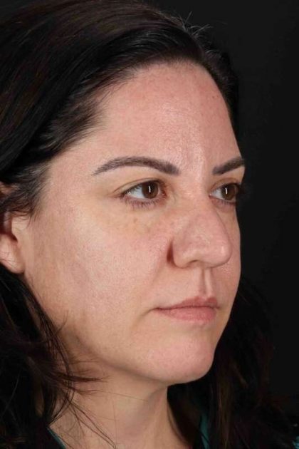 Browlift Before & After Patient #1363