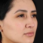 Rhinoplasty Before & After Patient #2895