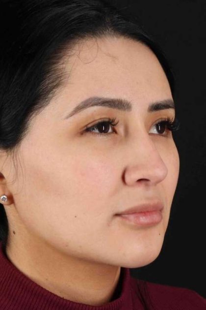 Rhinoplasty Before & After Patient #2895