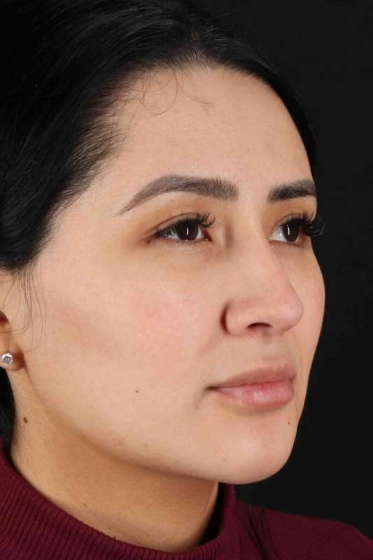 Rhinoplasty Before & After Patient #2895