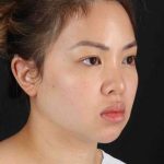 Rhinoplasty Before & After Patient #2906