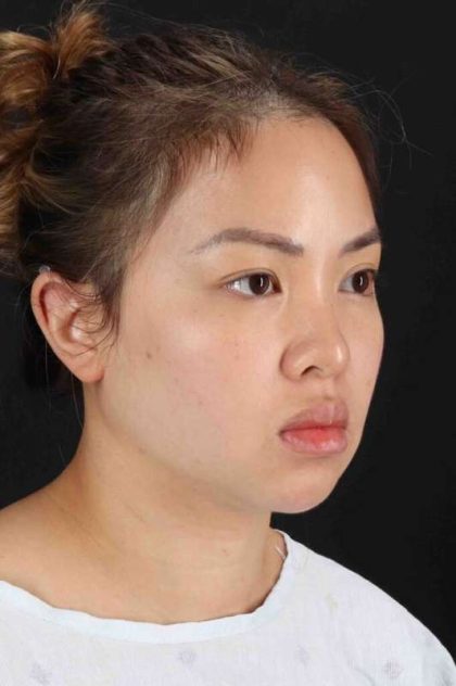 Rhinoplasty Before & After Patient #2906