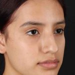 Rhinoplasty Before & After Patient #2917