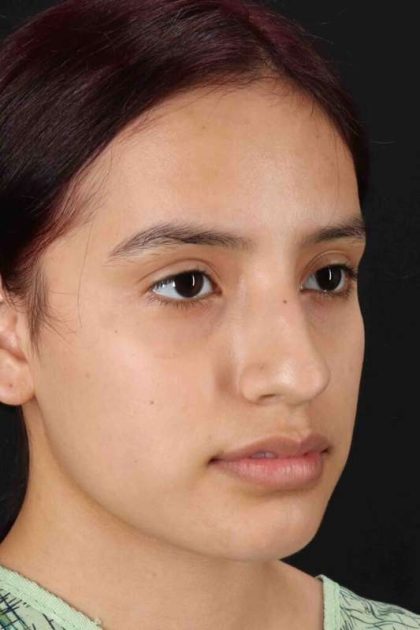 Rhinoplasty Before & After Patient #2917