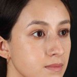 Rhinoplasty Before & After Patient #2928