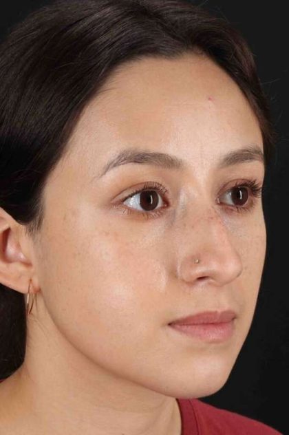 Rhinoplasty Before & After Patient #2928