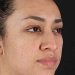 Rhinoplasty Before & After Patient #2939