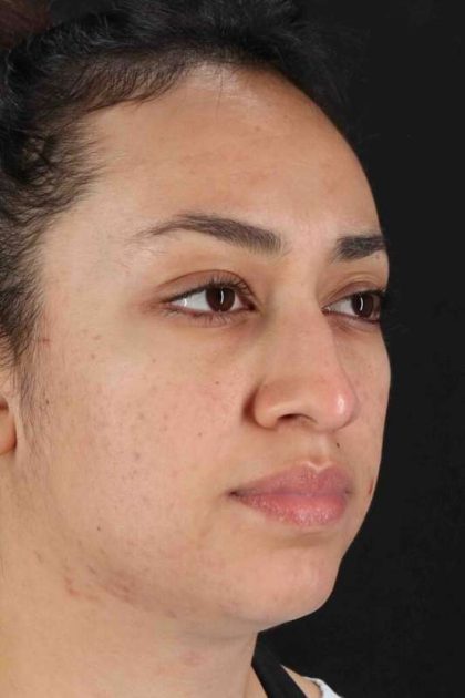 Rhinoplasty Before & After Patient #2939