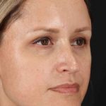 Rhinoplasty Before & After Patient #2950