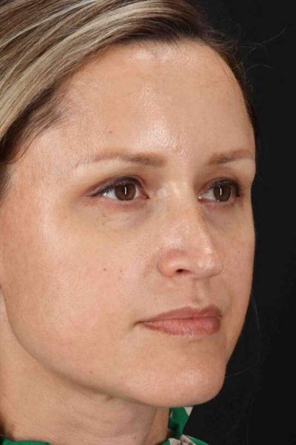 Rhinoplasty Before & After Patient #2950