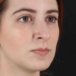 Rhinoplasty Before & After Patient #2961