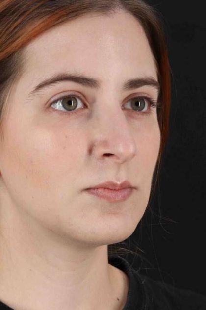 Rhinoplasty Before & After Patient #2961