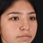 Rhinoplasty Before & After Patient #2972