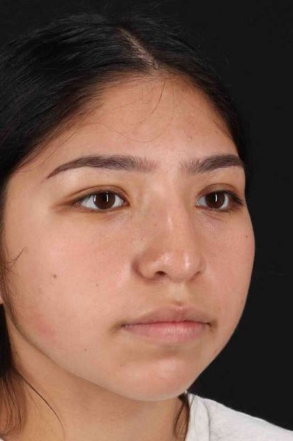 Rhinoplasty Before & After Patient #2972