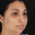 Rhinoplasty Before & After Patient #2994
