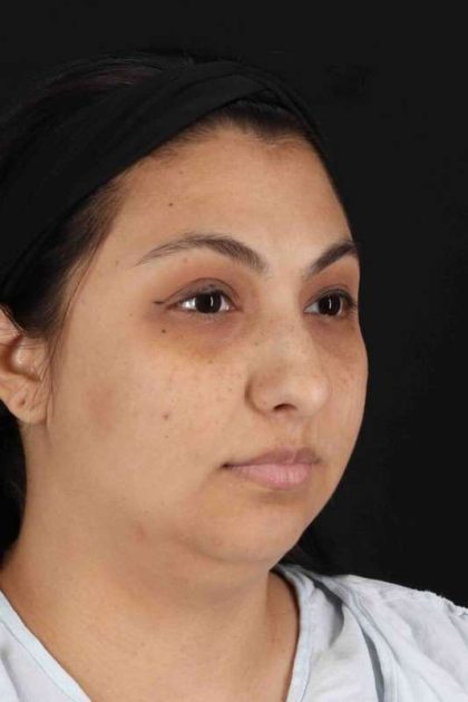 Rhinoplasty Before & After Patient #2994