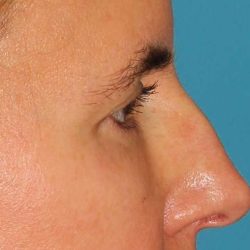 Browlift Before & After Patient #1373
