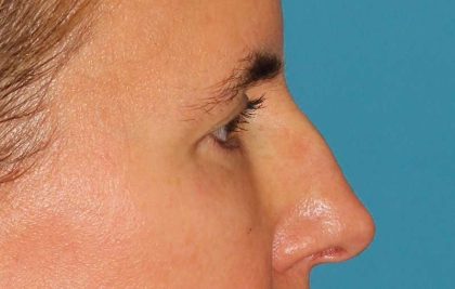 Browlift Before & After Patient #1373
