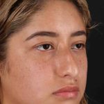 Rhinoplasty Before & After Patient #3016