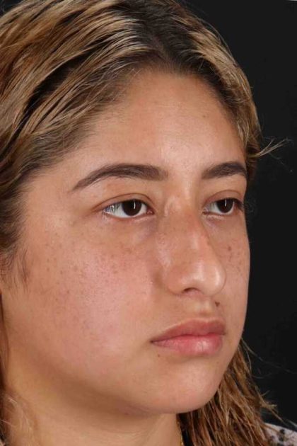Rhinoplasty Before & After Patient #3016