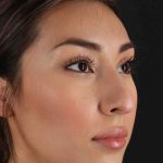 Rhinoplasty Before & After Patient #3027