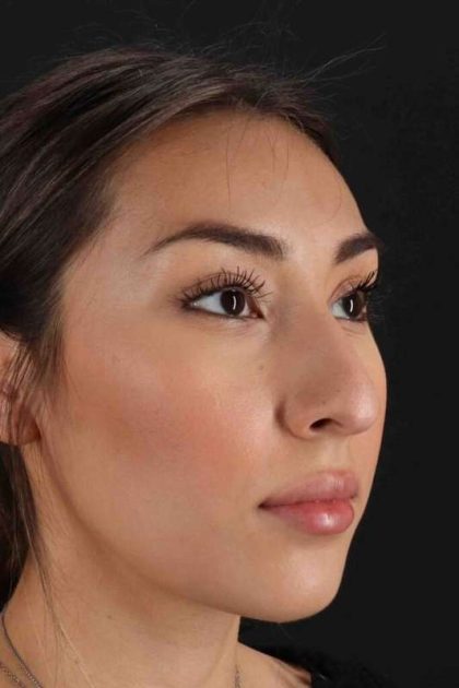 Rhinoplasty Before & After Patient #3027