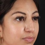 Rhinoplasty Before & After Patient #3049