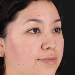 Rhinoplasty Before & After Patient #3060