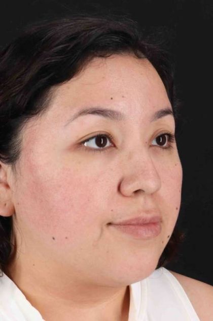 Rhinoplasty Before & After Patient #3060