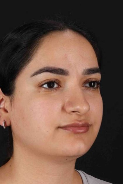 Rhinoplasty Before & After Patient #3071