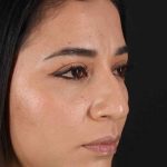 Rhinoplasty Before & After Patient #3082