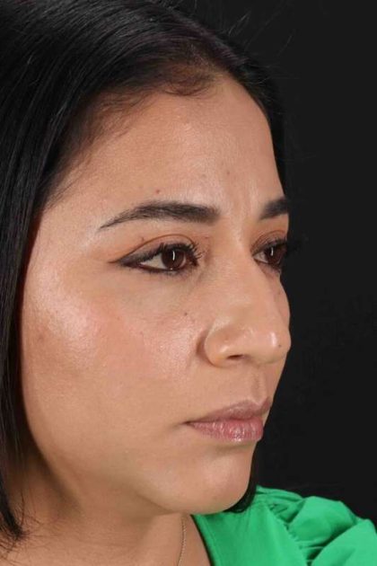 Rhinoplasty Before & After Patient #3082