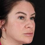 Rhinoplasty Before & After Patient #3093