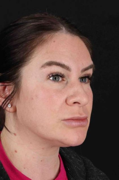 Rhinoplasty Before & After Patient #3093