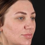 Rhinoplasty Before & After Patient #3104
